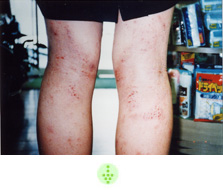 ⑫【足】16才の頃　足の湿疹、治っては悪化の繰り返し