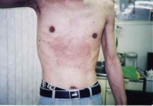 上半身 体中に赤いブツブツの塊 顔と腋が色素沈着で真っ黒 アトピースキンケア方法相談 くすりのファイン