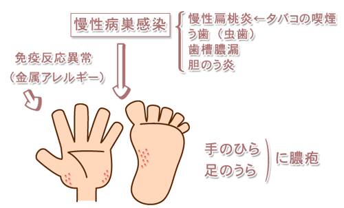 掌蹠膿疱症の原因