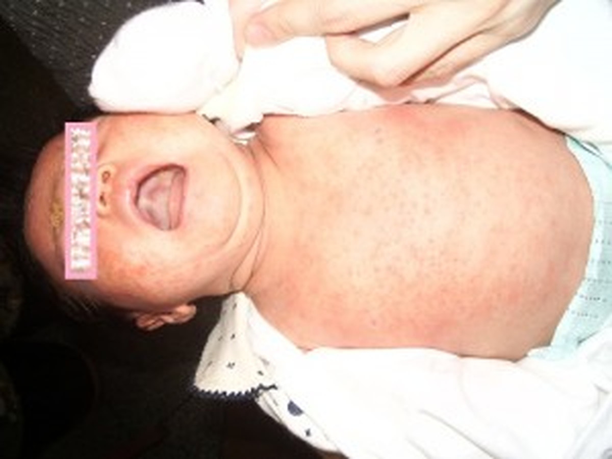 脂漏性湿疹の赤ちゃん（対策前）