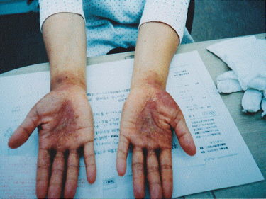 ⑤【手湿疹】手の指先の荒れから始まり、手首まで皮むけで痛い（アトピー）