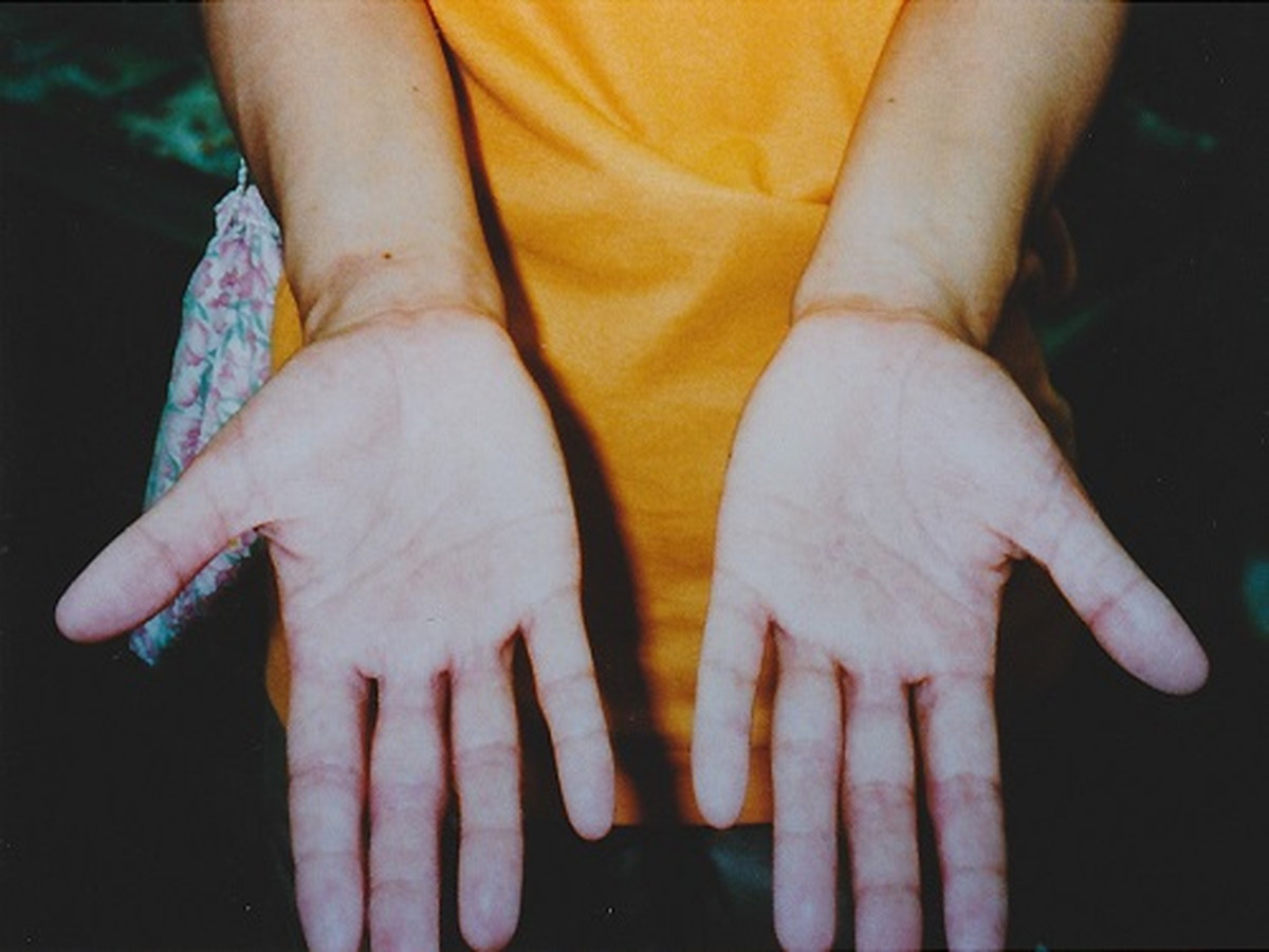 手湿疹～ストレス画像（対策後）