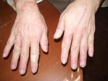 ⑥【手湿疹】10年前から手湿疹、手の平・手の甲が真っ赤に
