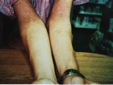 ⑪【腕】腕の肘から上、茶褐色の湿疹状態