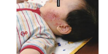 ④【顔】生後4か月頃から顔に湿疹（赤ちゃんアトピー治し方）