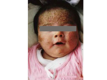 ⑤【顔】生後3ヶ月、顔を中心にブツブツの湿疹が拡がる