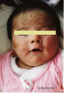 顔 生後3ヶ月 顔を中心にブツブツの湿疹が拡がる アトピースキンケア方法相談 くすりのファイン