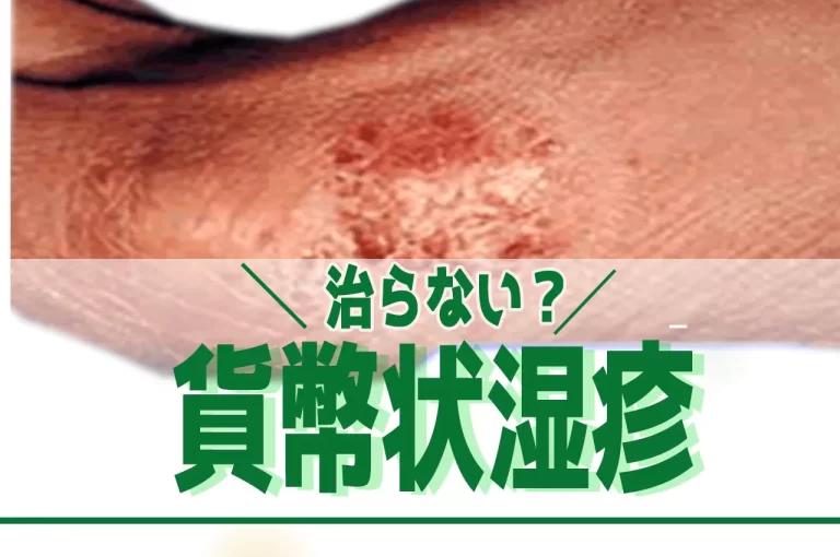 貨幣状湿疹の治療選択肢