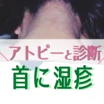 首に湿疹(対策前写真)