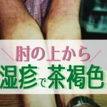 肘の上から皮膚炎