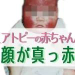 アトピー で顔が真っ赤な赤ちゃん（写真）