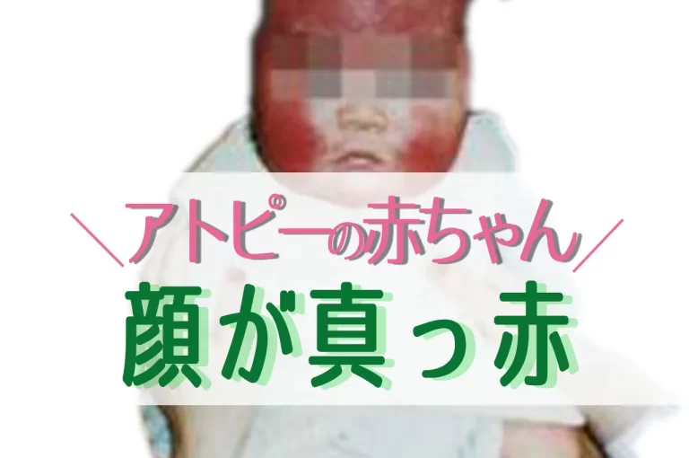 アトピー で顔が真っ赤な赤ちゃん（写真）