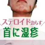 首に湿疹（対策前）